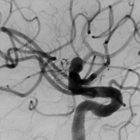 De-identified DSA image, case 61, view b